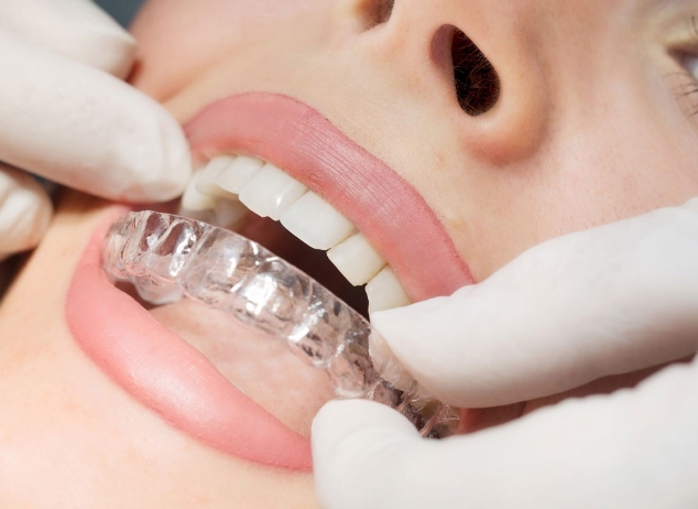 Nachtbeugel - Orthodontiepraktijk Leidsche Rijn