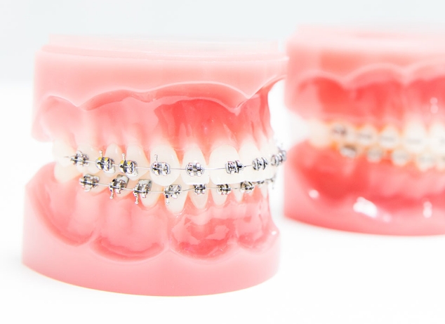 Slotjesbeugel behandelingen - Orthodontiepraktijk Leidsche Rijn