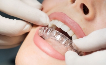 Nachtbeugel behandeling - Orthodontiepraktijk Leidsche Rijn