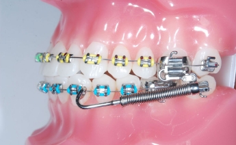 Forsus behandeling - Orthodontiepraktijk Leidsche Rijn