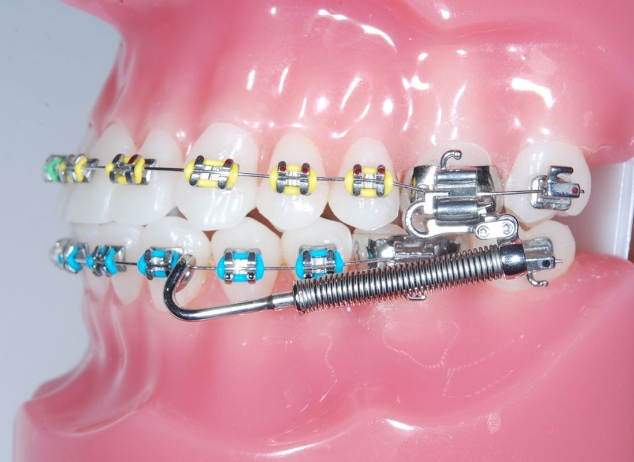 Forsus behandeling - Orthodontiepraktijk Leidsche Rijn