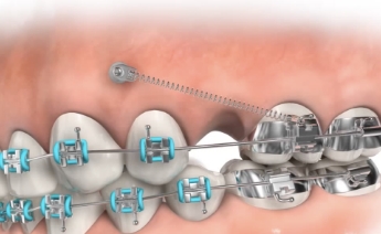 Mini Implantaat behandeling - Orthodontiepraktijk Leidsche Rijn