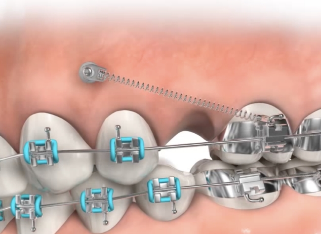 Mini Implantaat behandeling - Orthodontiepraktijk Leidsche Rijn